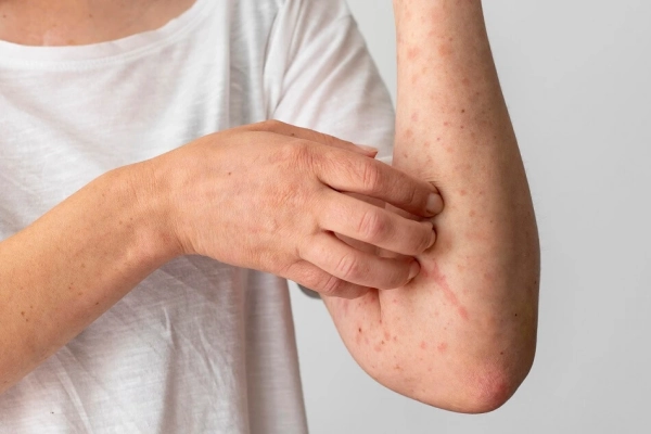 Alergia a los alimentos